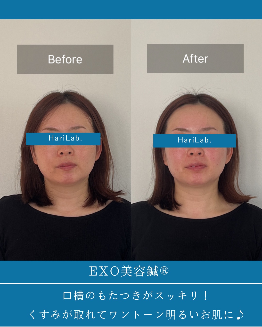 2025.04.2630代女性の美容鍼体験談