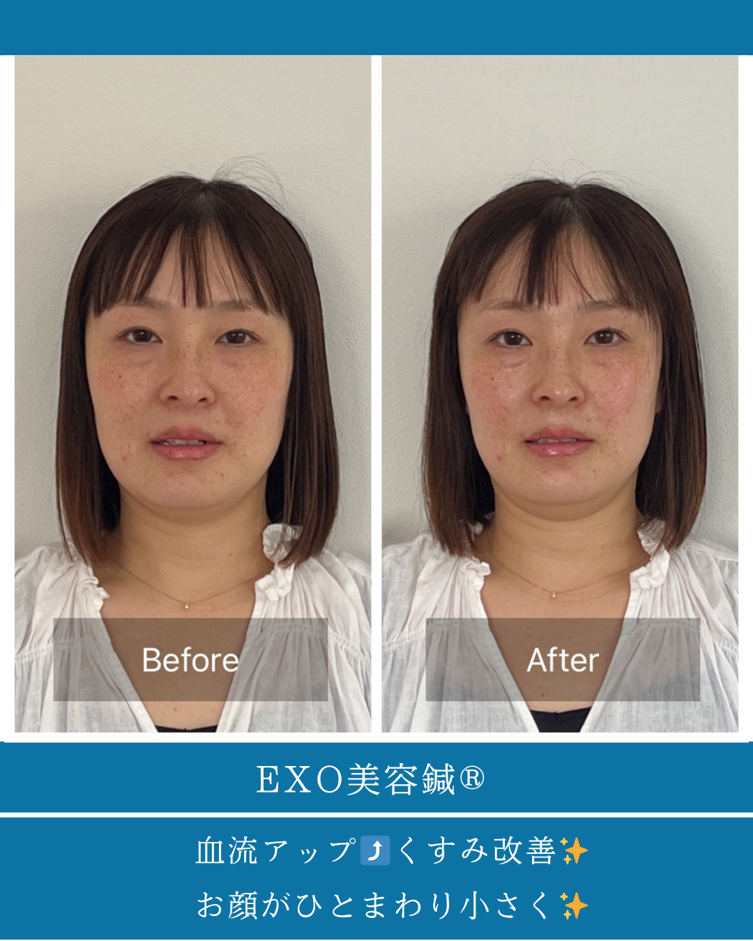2025.08.0830代女性の美容鍼体験談